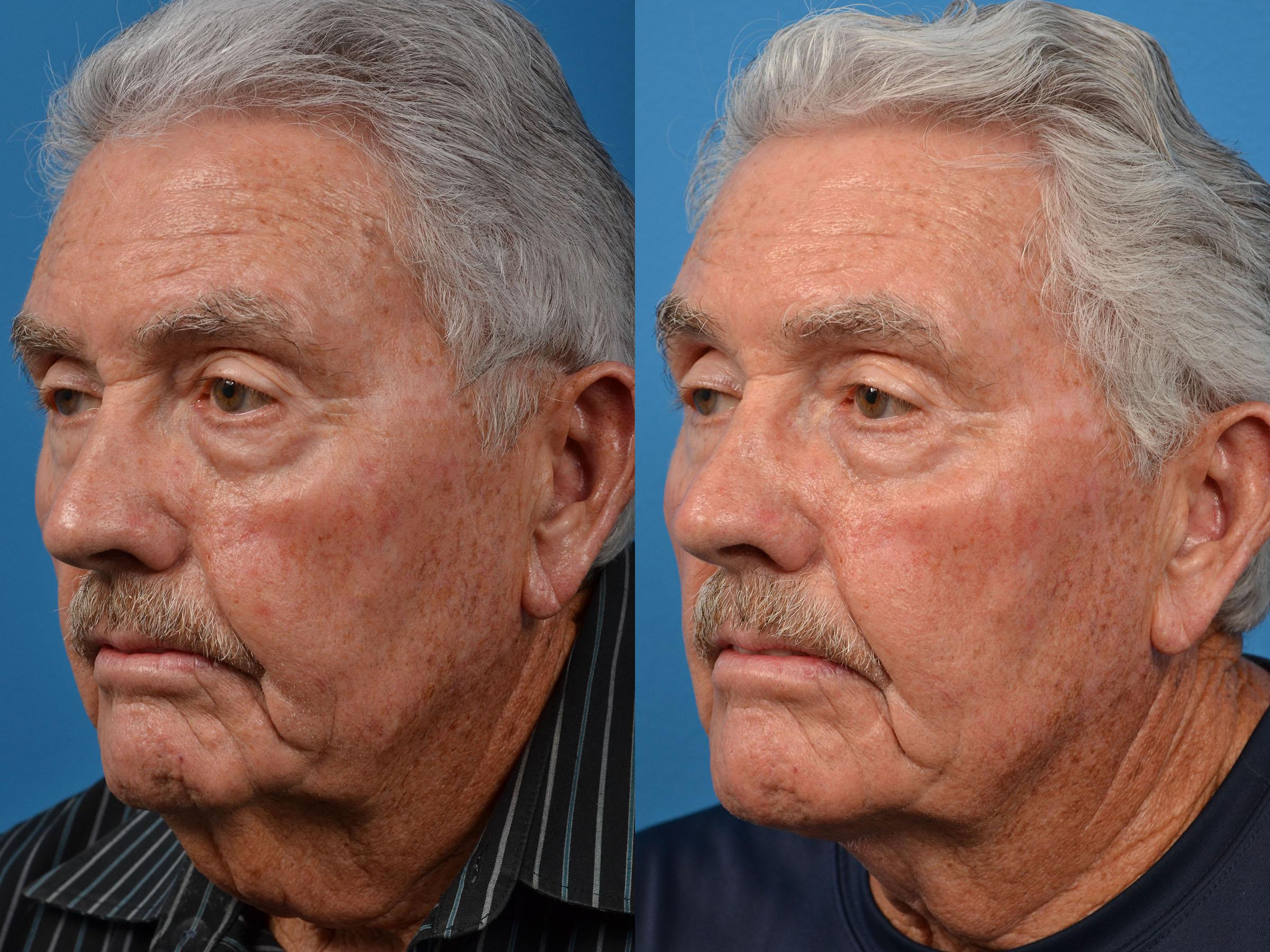 Male Neck Lift Photos Melbourne FL Patient 56740   Patient 56740 4 